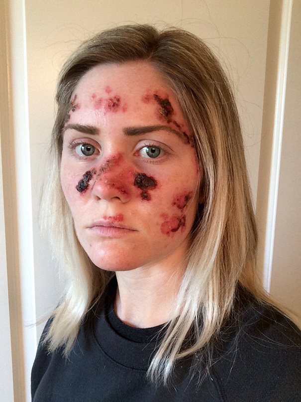 Esta mujer con cáncer de piel publica un selfie muy gráfico para advertir sobre los peligros de broncearse