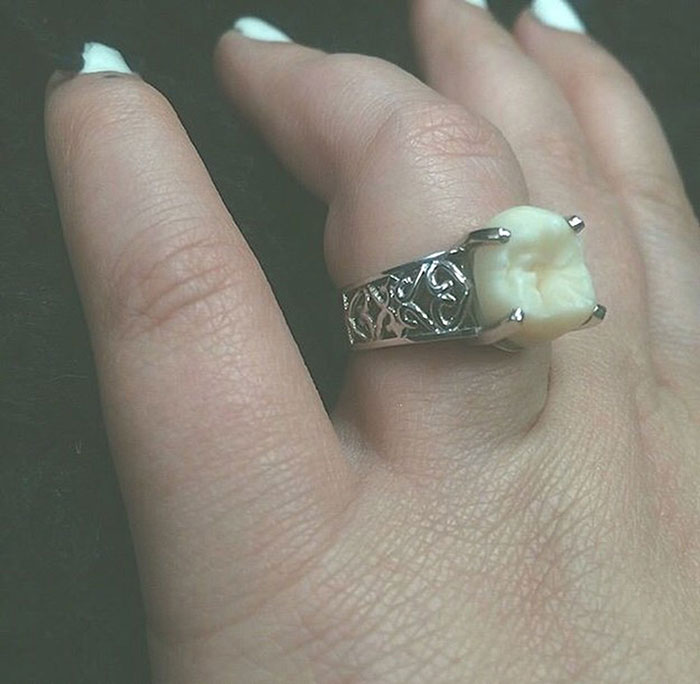 Esta mujer recibió un anillo de compromiso con una muela del juicio de su prometido