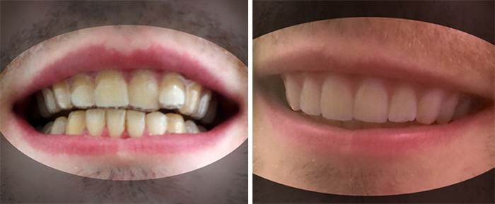 aparato-ortodoncia-impreso-3d-amos-dudley (1)