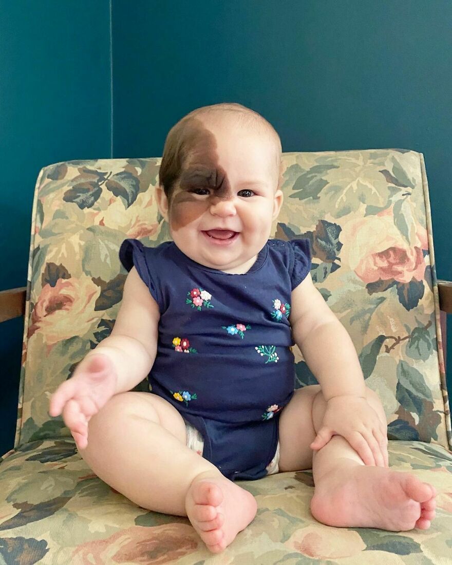 Esta bebé nació con una llamativa marca de nacimiento, y su familia lucha por normalizar su aspecto