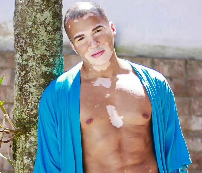 De la sombra a la luz: Este brasileño dejó de ocultar su vitiligo para triunfar como modelo