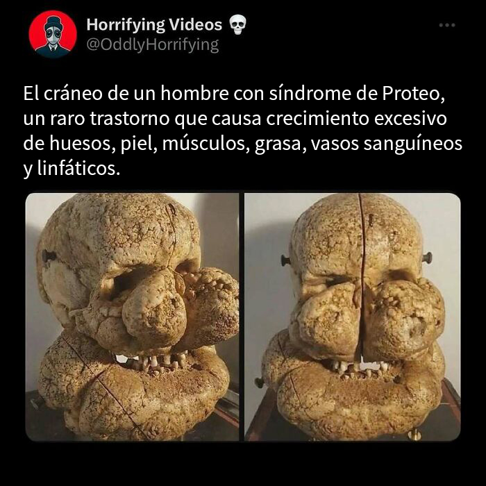 Cráneo deformado por síndrome de Proteo, imagen extrañamente aterradora que genera inquietud y curiosidad visual.