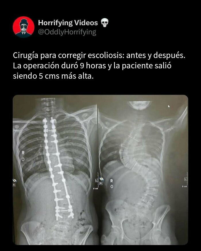 Radiografía de cirugía para corregir escoliosis mostrando imágenes extrañamente aterradoras del antes y después.