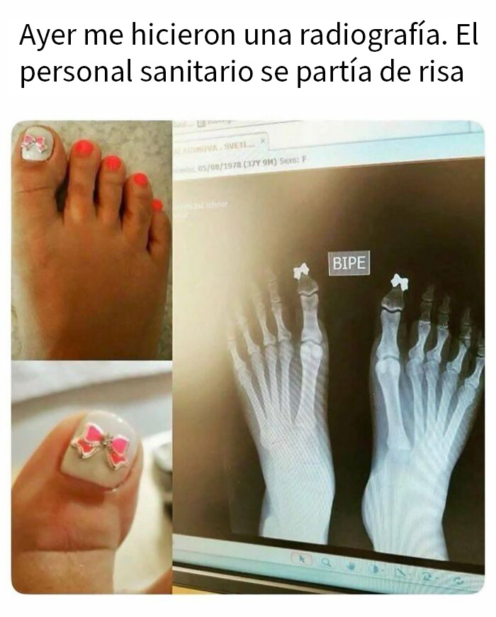 Radiografía de pie con decoración de la uña, imagen divertida para memes aleatorios de risas y caos.