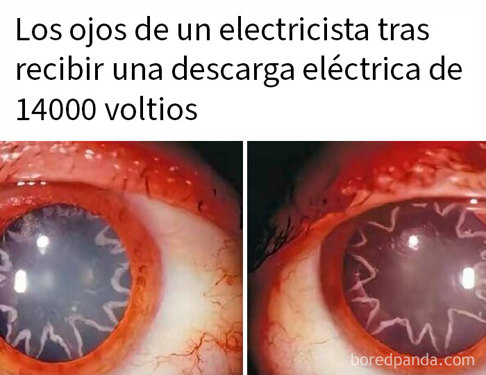 Ojos afectados de un electricista tras recibir una descarga eléctrica, imagen impactante y publicaciones bastante interesantes.