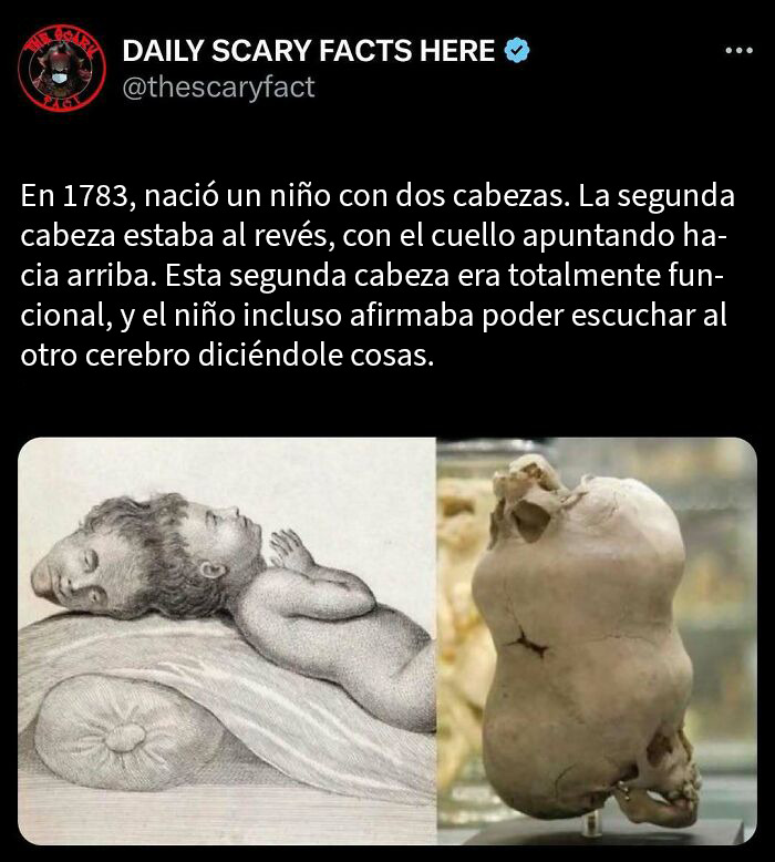 Bebé con dos cabezas funcionales y datos terroríficos sobre anomalías raras de nacimiento en historia médica.