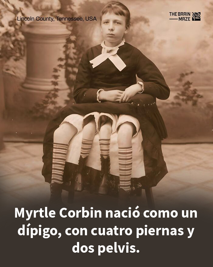 Mujer con dipygus mostrando cuatro piernas y dos pelvis, hecho interesante sobre la mente y el cuerpo humano.