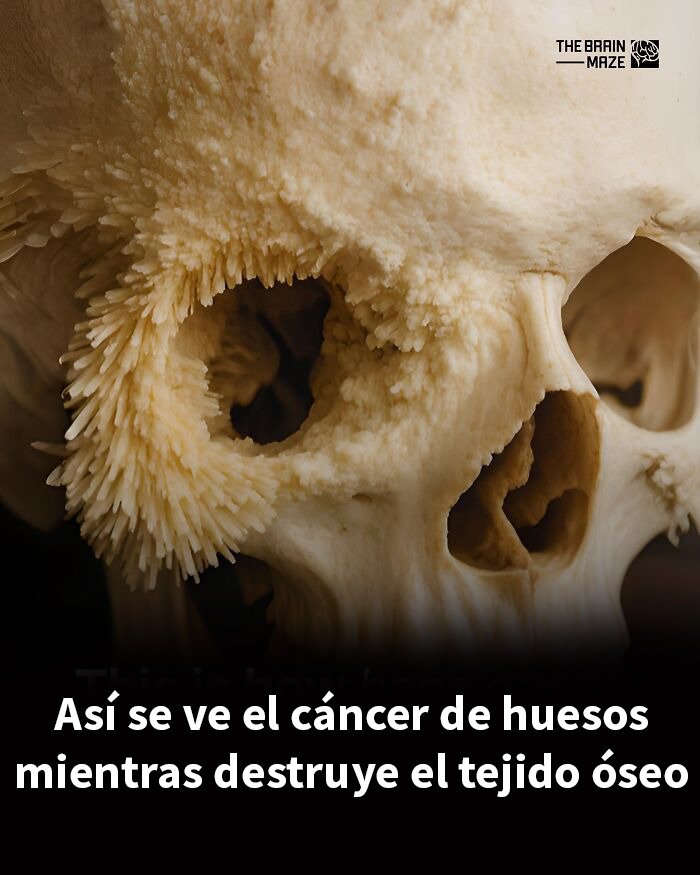 Craneo con cáncer óseo mostrando cómo esta enfermedad destruye el tejido óseo, hechos interesantes sobre la mente y el cuerpo.