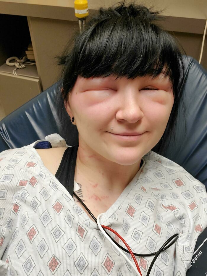 Mujer en el hospital con los ojos hinchados tras una mala experiencia en el salon de belleza