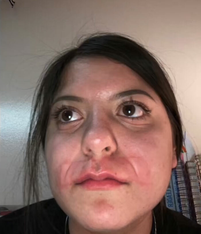 Rostro de una mujer con marcas rojas alrededor de la boca tras salir de un salon de belleza