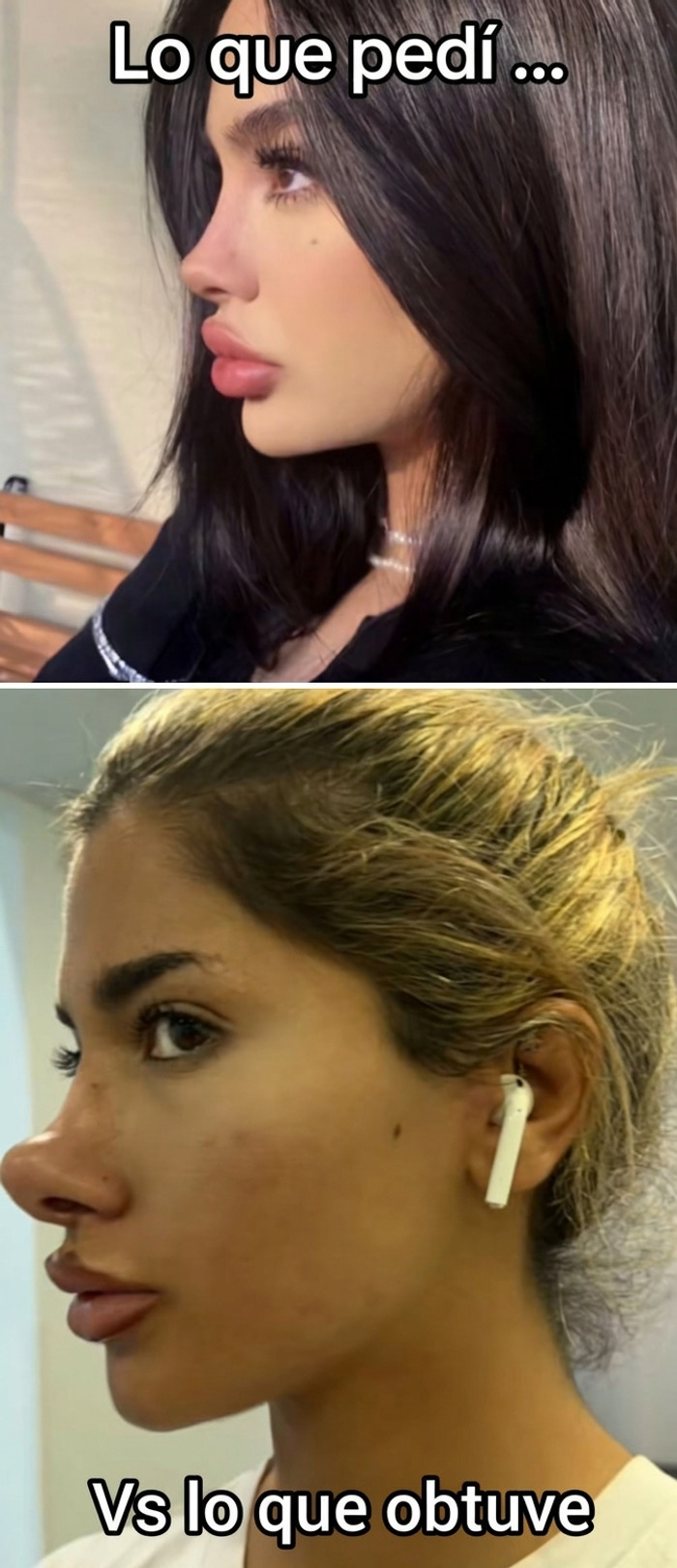 Comparativa de expectativa y realidad de una rinoplastia fallida hecha en un salon de belleza