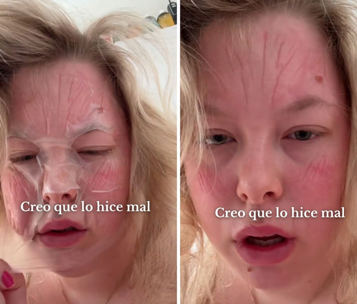 Joven con el rostro irritado tras un tratamiento fallido en el salón de belleza.