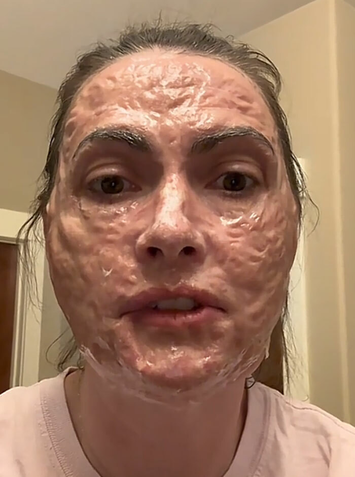 Rostro de mujer con reaccion alergica severa por un procedimiento en el salon de belleza