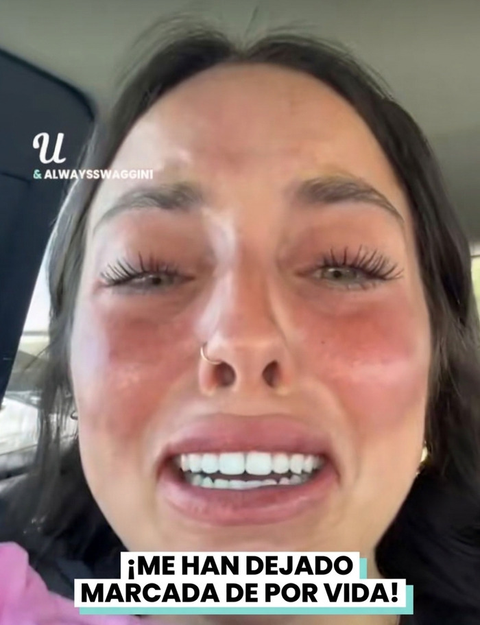 Mujer llorando y disgustada con marcas en su rostro por un mal tratamiento de belleza