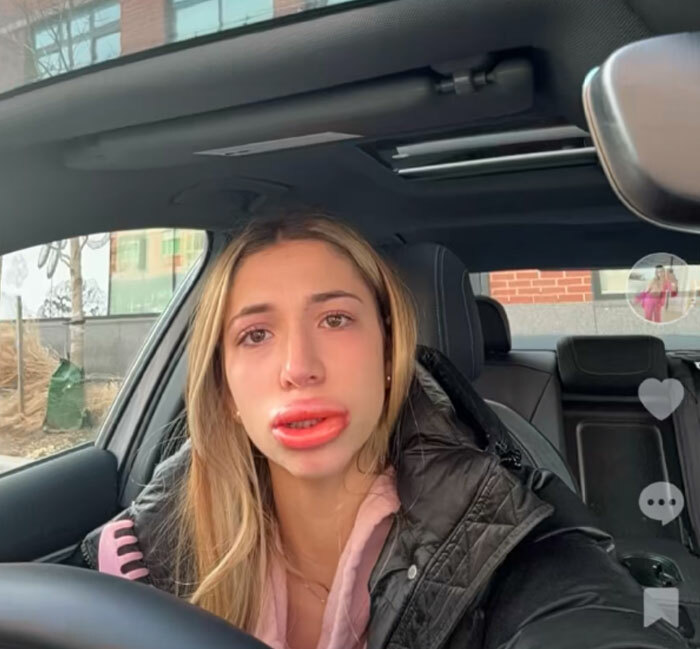 Mujer con labios hinchados y arrepentida tras salir del salon de belleza