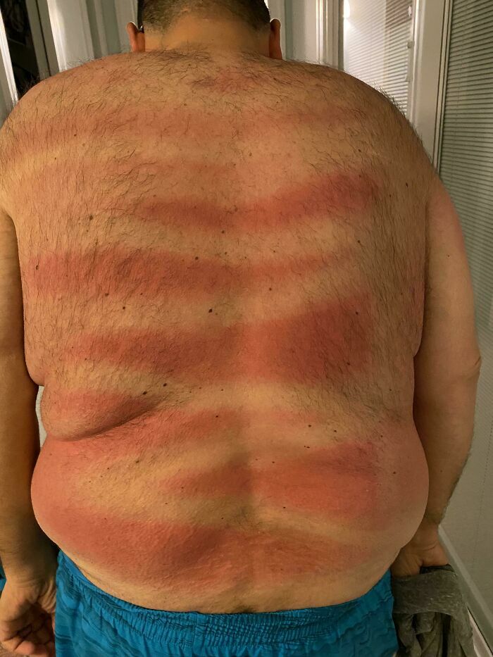 Hombre con quemaduras de sol con rayas en la espalda hechas por novias y esposas