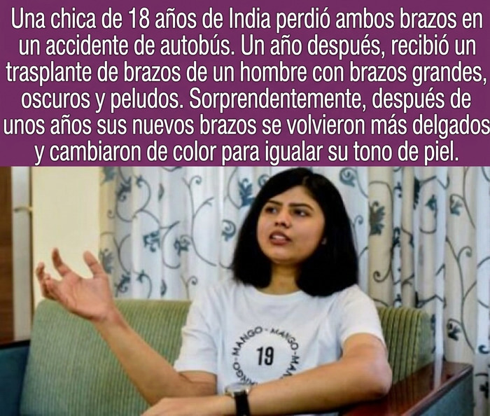 Datos curiosos: Una joven de la India muestra sus brazos trasplantados que cambiaron de tono de piel.