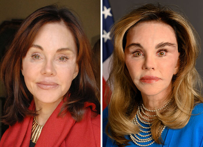 Mujeres del círculo de Trump con transformaciones faciales polémicas