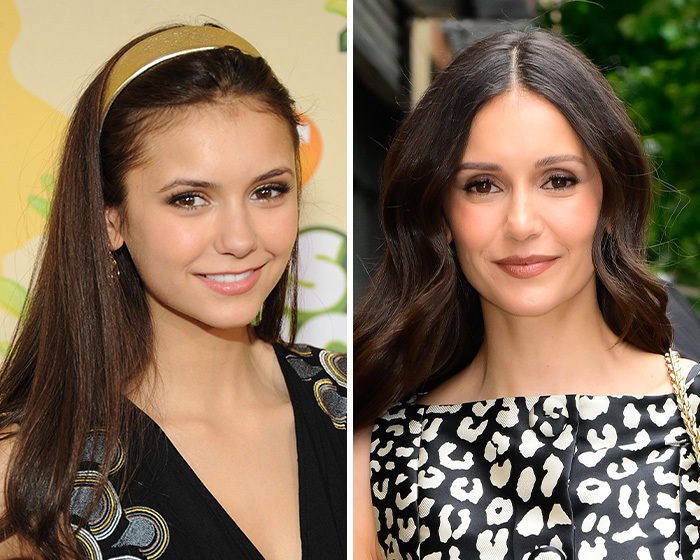 Comparación del rostro de Nina Dobrev mostrando los efectos de una blefaroplastia.